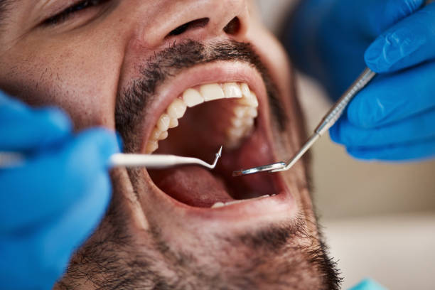 Best Emergency Wisdom Teeth Removal in Wixom, MI
